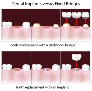 Dental Implants, Dental Bridges Ringwood