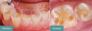 Worn Teeth - Attrition Erosion - Ringwood