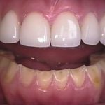 Are Worn Teeth a Cause for Concern?