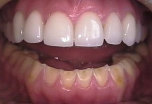 Worn Teeth - Caus for Concern - East Ringwood Dental Clinic